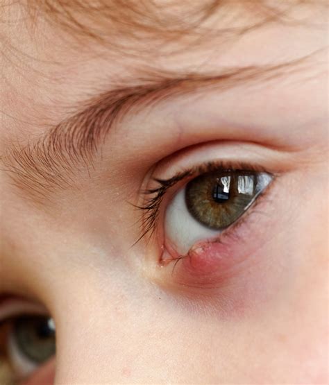 Corneal Staph Infection