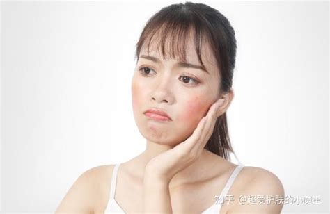 皮肤换季过敏怎么办？这里有小妙招 知乎