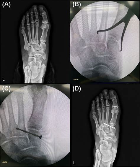 Figure From Suture Button Vs Conventional Screw Fixation For Isolated