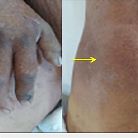 Swollen Edematous And Deformed Joints Of The Hand A And Knee B