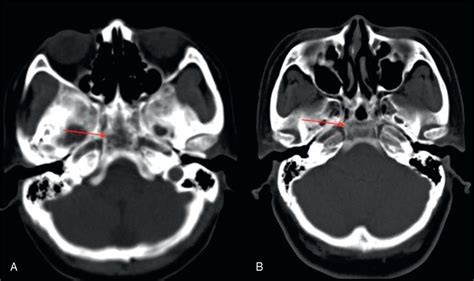 Bone Window Of An A Axial Ct Scan Demonstrates The Bony Irregular Download Scientific Diagram