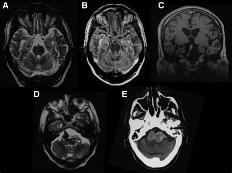 From Basilar Artery Dolichoectasia To Basilar Artery Aneurysm Natural