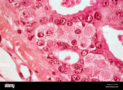 Prostate Cancer Histology Stock Photo Alamy