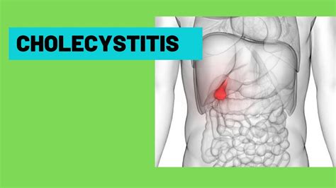 Cholecystitis Acute Cholecystitis Murphys Sign Signs Symptoms