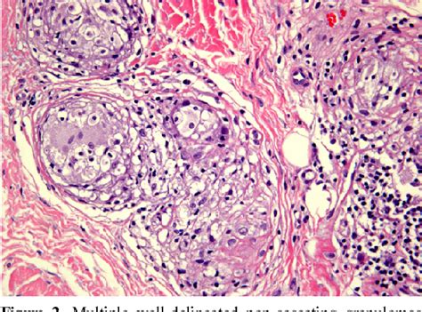 Figure 2 From A Case Of Sarcoidosis Presenting With Multiple Papules