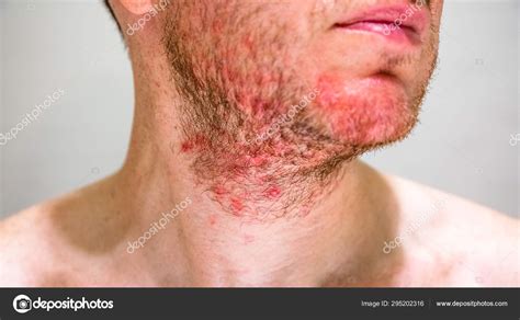 Homem Dermatite Seborreica Na Zona Da Barba Fotos Imagens De