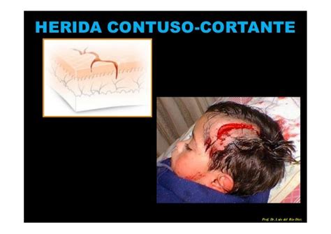 Heridas Traumatismos AnestÉsicos Locales Y Tipos De Cierres Prof