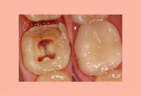 Pediatric Endodontics Moses