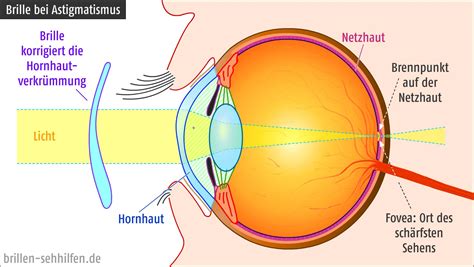 Hornhautverkrümmung Ursache von Astigmatismus bzw Stabsichtigkeit