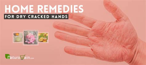 10 Effective And Best Home Remedies For Dry Cracked Hands