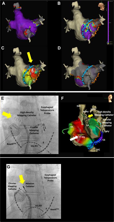 The Ensite Abbott A D F And Fluoroscopic E G Images During The