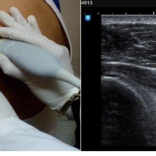 Musculoskeletal Ultrasound Guided Steroid Injection By The Glenohumeral