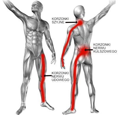 Korzonki Objawy Zapalenia Korzonk W Przyczyny I Leczenie