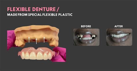 DISCOVER OUR PREMIUM FLEXI DENTURES BY MAIL