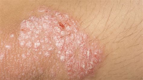 Como Tratar La Psoriasis Genital