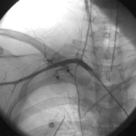 Contrast Extravasation Arrow In The Right Subclavian Artery On Download Scientific Diagram