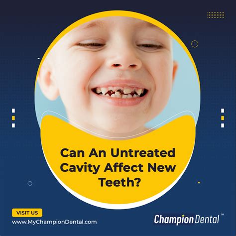 Baby Teeth Cavity Should It Be Filled Or Not Champion Dental