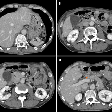 Computed Tomography Findings After Neoadjuvant Chemotherapy A 3 Download Scientific Diagram