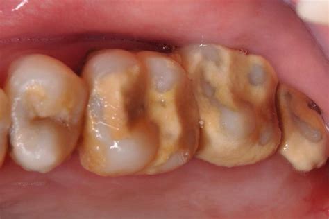 Dental Scaling - AlQudrahMC