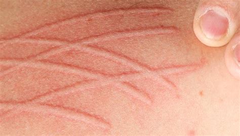 Dermatographia Symptoms Causes Treatment And More