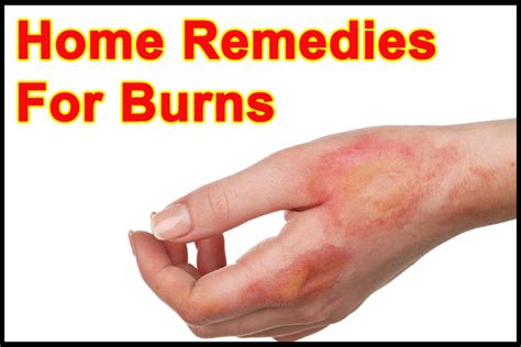 Home Remedies For Burns Home Remedies For Burns