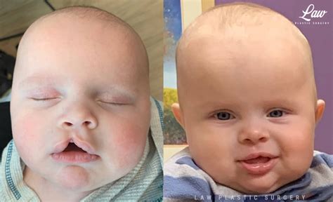 Cleft Lip Repair Primary Unilateral Before And After Photos Law Plastic Surgery