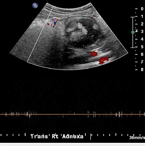 Doppler Ultrasound Of The Right Ovary Showing A 5 Cm Teratoma But With Download Scientific