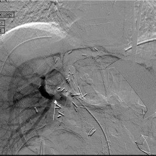 Pre Intervention Direct Portal Venogram Demonstrating A Filling Defect