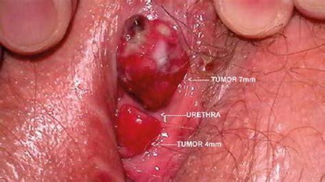 Vulvar Melanoma Staging