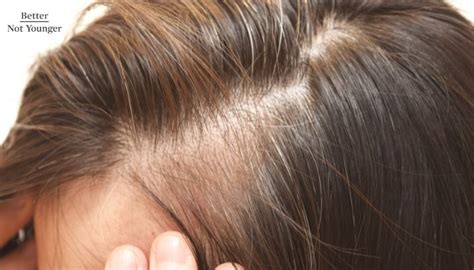 Top 10 Solutions For Womens Front Hair Thinning Bny