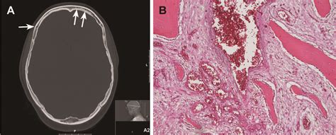 Hemangioma Of Bone A Radiology Conventional X Ray Of The Scalp