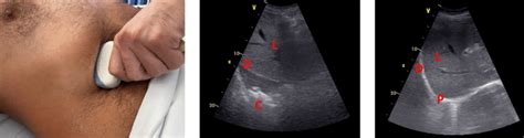 Positioning Of The Ultrasound Probe In Order To Perform A Trans Hepatic Download Scientific