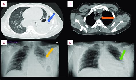 A Ct Of The Chest Shows Empyema On The Right Lung Blue Arrow