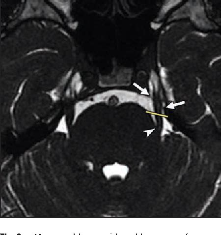 Trigeminal Nerve Anatomy Mri