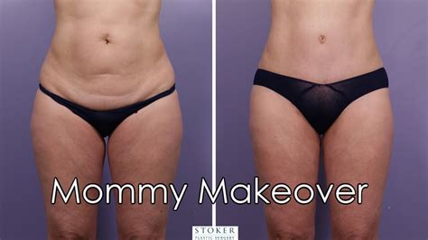 Mommy Makeover Los Angeles Plastic Surgeon Dr David Stoker Completes