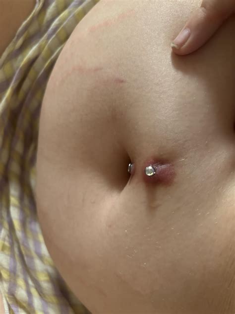 Potentially Rejected Navel Piercing How To Reduce Scarring R Piercingadvice