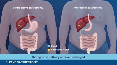 Weu Bariatric Animation Sleeve Gastrectomy Unbranded Youtube