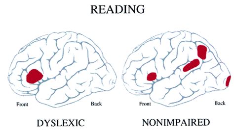 The Causes Of Dyslexia What The Latest Science Reveals