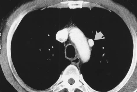 Incidentally Detected Cardiovascular Abnormalities On Helical CT