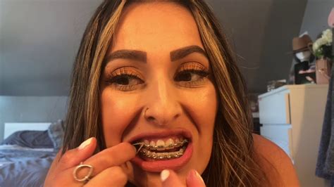 Braces Update Elastics Youtube