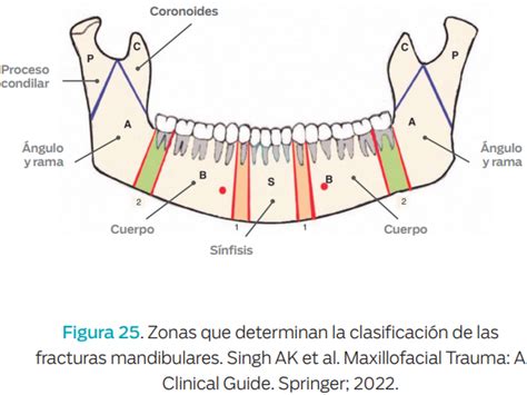 Clasificaci N De Fractura De Mand Bula