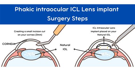 Phakic Iol Alternatif Lasik Untuk Sembuhkan Mata Minus Tinggi