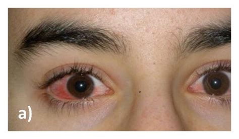 Severe Conjunctival Redness In A Male With Vernal Keratoconjunctivitis Download Scientific