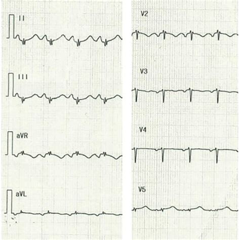 Electrocardiogram Electrocardiography Revealed Sinus Tachycardia Low