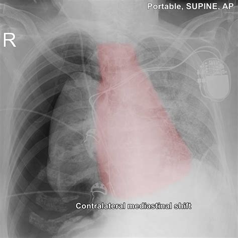 Tension Pneumothorax Causes Symptoms Diagnosis Treatment And Prognosis