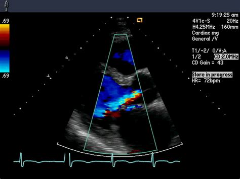 Doppler Ultrasound Modern Heart And Vascular