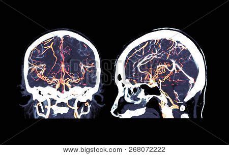 Ct Angiography Brain Image Photo Free Trial Bigstock