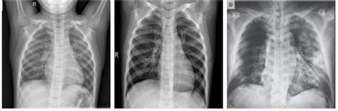 CXR images with differece class (a) normal, (b) viral pneumonia, and ...