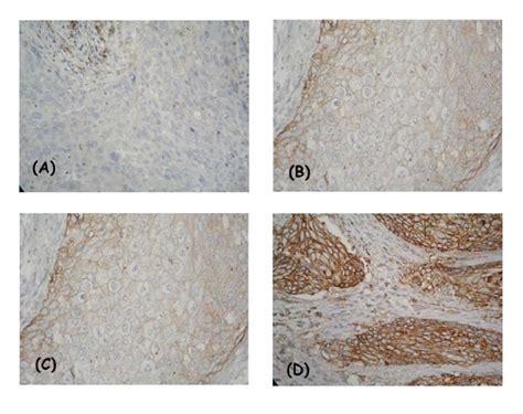 IHC Expression Model Of CD47 In Squamous Cell Cervical Cancer Membrane