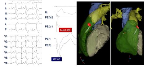 Ablation Of Idiopathic Premature Ventricular Contractions Originating